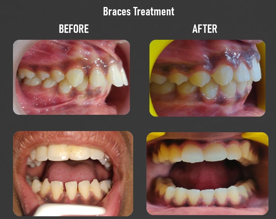 Braces Treatment Transformation